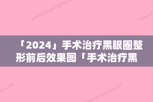 「2024」手术治疗黑眼圈整形前后效果图「手术治疗黑眼圈手术的效果真实」