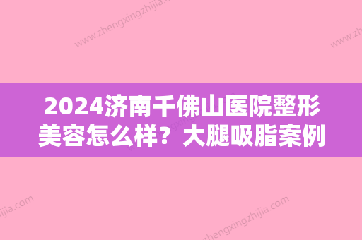 2024济南千佛山医院整形美容怎么样？大腿吸脂案例让你更加美丽自信