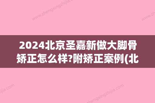 2024北京圣嘉新做大脚骨矫正怎么样?附矫正案例(北京海淀区大脚骨矫正圣嘉新)