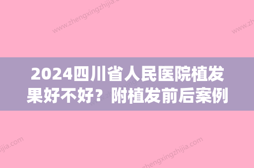 2024四川省人民医院植发果好不好？附植发前后案例对比(四川省人民医院 植发)