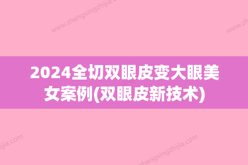 2024全切双眼皮变大眼美女案例(双眼皮新技术)