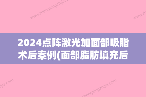 2024点阵激光加面部吸脂术后案例(面部脂肪填充后多久可以做点阵激光)