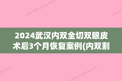 2024武汉内双全切双眼皮术后3个月恢复案例(内双割双眼皮恢复期多久)