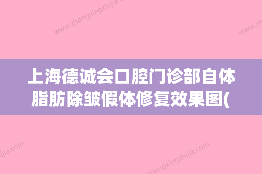 上海德诚会口腔门诊部自体脂肪除皱假体修复效果图(上海德诚资本)