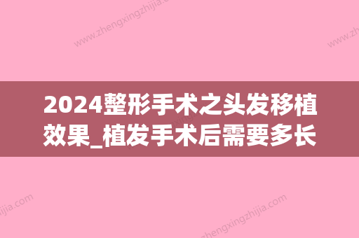 2024整形手术之头发移植效果_植发手术后需要多长时间整形效果更直观