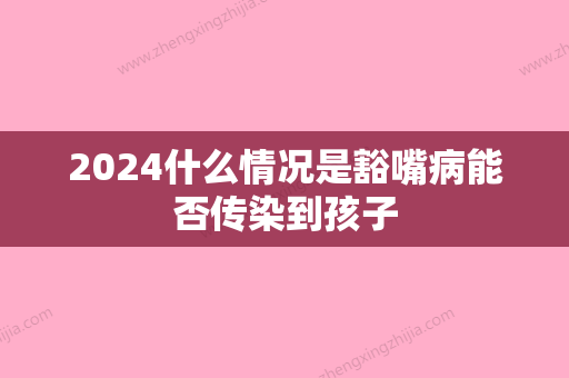 2024什么情况是豁嘴病能否传染到孩子