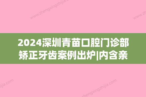 2024深圳青苗口腔门诊部矫正牙齿案例出炉|内含亲身体验感悟(深圳青苗儿童口腔)