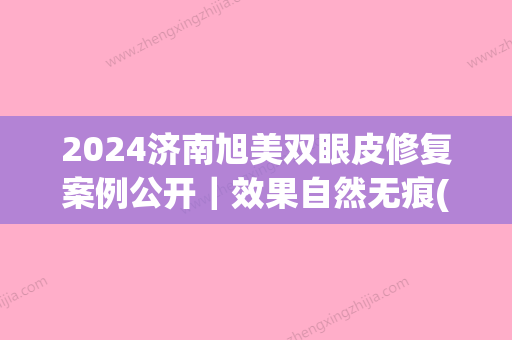 2024济南旭美双眼皮修复案例公开｜效果自然无痕(济南旭美哪个医生做双眼皮)