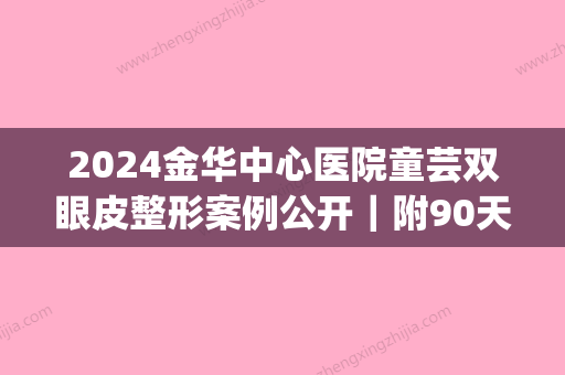 2024金华中心医院童芸双眼皮整形案例公开｜附90天恢复细节图(童芸金华中心医院整形外科)