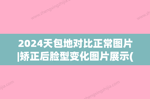 2024天包地对比正常图片|矫正后脸型变化图片展示(地包天矫正前后对比图)