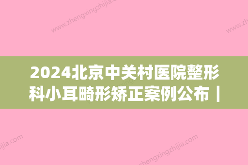 2024北京中关村医院整形科小耳畸形矫正案例公布｜效果自然美观(小耳畸形整形手术)