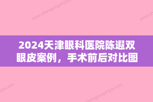 2024天津眼科医院陈遐双眼皮案例，手术前后对比图片展示