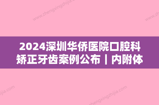 2024深圳华侨医院口腔科矫正牙齿案例公布｜内附体验效果图