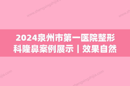 2024泉州市第一医院整形科隆鼻案例展示｜效果自然美观(泉州三甲医院整形科)