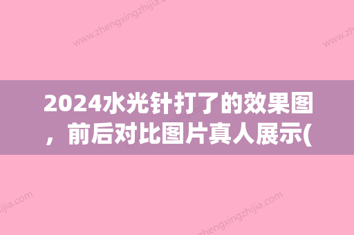 2024水光针打了的效果图，前后对比图片真人展示(水光针打完对比图)