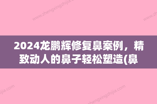 2024龙鹏辉修复鼻案例，精致动人的鼻子轻松塑造(鼻综合修复过程)