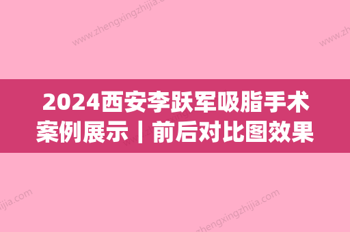 2024西安李跃军吸脂手术案例展示｜前后对比图效果让人惊讶(西安吸脂整形手术)