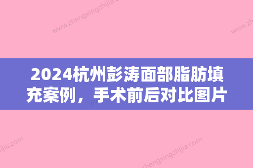 2024杭州彭涛面部脂肪填充案例，手术前后对比图片展示