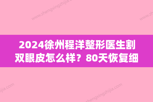 2024徐州程洋整形医生割双眼皮怎么样？80天恢复细节图公布(徐艺洋割双眼皮)