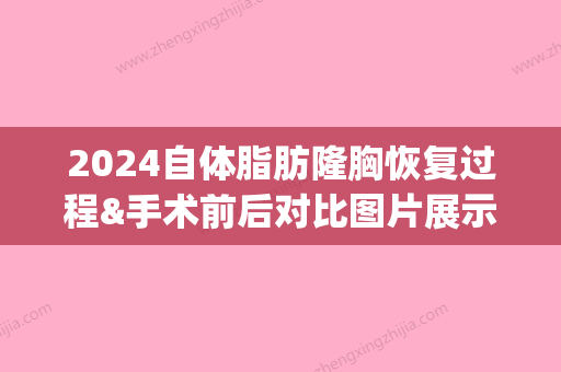 2024自体脂肪隆胸恢复过程&手术前后对比图片展示(自体脂肪隆胸恢复期图片)