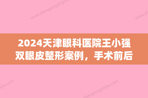 2024天津眼科医院王小强双眼皮整形案例，手术前后对比图(王小强双眼皮手术做得怎么样)