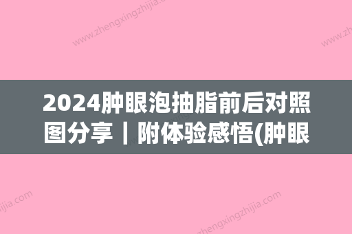 2024肿眼泡抽脂前后对照图分享｜附体验感悟(肿眼泡抽脂前后对比图)