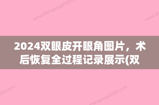 2024双眼皮开眼角图片，术后恢复全过程记录展示(双眼皮手术三天后照片)