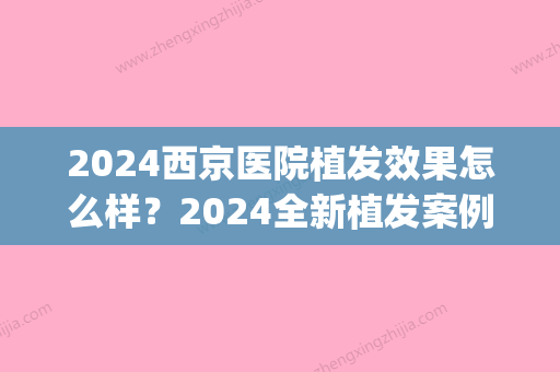 2024西京医院植发效果怎么样？2024全新植发案例分享(西京医院头发移植需要多少钱)