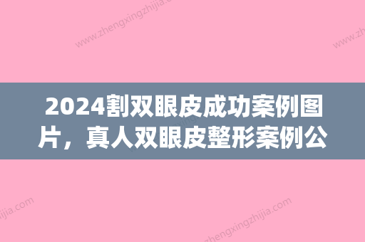 2024割双眼皮成功案例图片，真人双眼皮整形案例公布(割双眼皮初期图片)