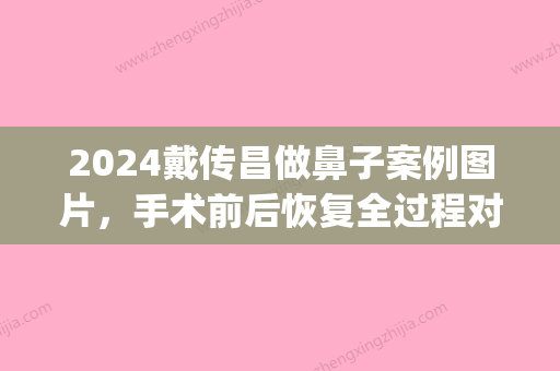 2024戴传昌做鼻子案例图片，手术前后恢复全过程对比(戴传昌 鼻翼缩小)