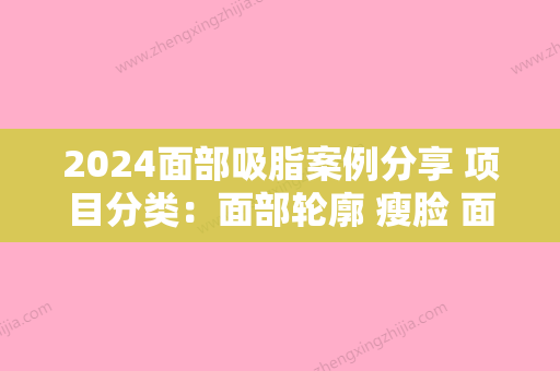 2024面部吸脂案例分享 项目分类：面部轮廓 瘦脸 面部吸脂