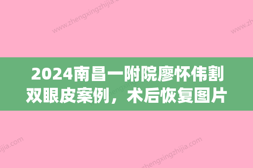 2024南昌一附院廖怀伟割双眼皮案例，术后恢复图片鉴赏，眼睛超美(南昌一附院割双眼皮医生)