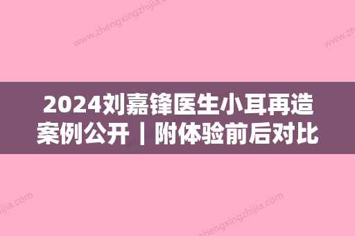 2024刘嘉锋医生小耳再造案例公开｜附体验前后对比图