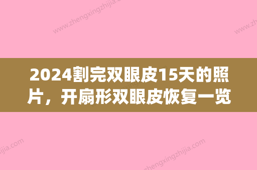 2024割完双眼皮15天的照片，开扇形双眼皮恢复一览(割双眼皮3天后图片)