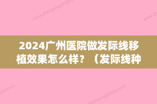 2024广州医院做发际线移植效果怎么样？（发际线种植手术疼吗）(发际线移植手术需要多长时间)