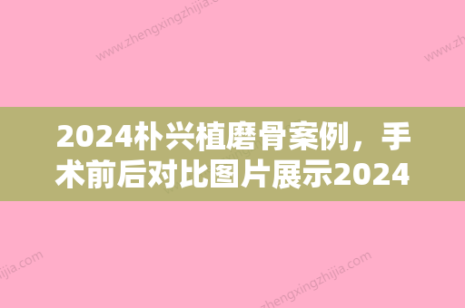 2024朴兴植磨骨案例，手术前后对比图片展示2024