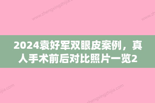 2024袁好军双眼皮案例，真人手术前后对比照片一览2024(袁艺 双眼皮)