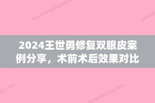 2024王世勇修复双眼皮案例分享，术前术后效果对比图展示(王世勇修复双眼皮要多少钱)