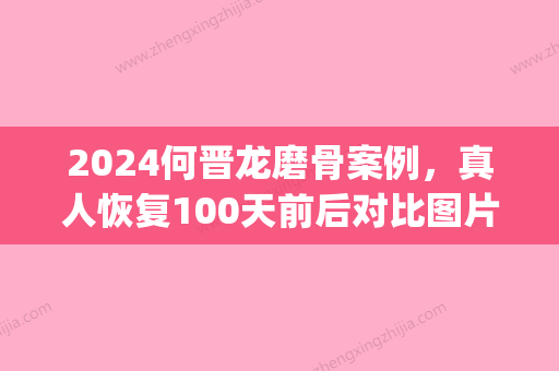 2024何晋龙磨骨案例，真人恢复100天前后对比图片(何晋龙磨骨效果好吗)