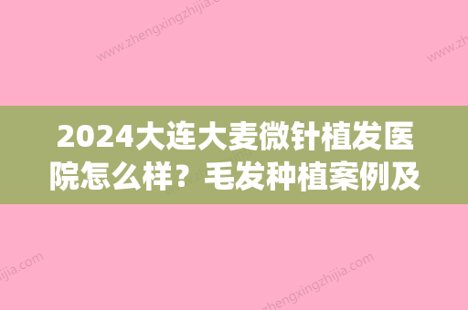 2024大连大麦微针植发医院怎么样？毛发种植案例及效果图分享(大麦微针植发沈阳)