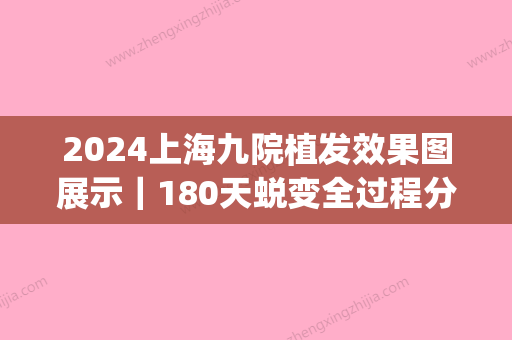 2024上海九院植发效果图展示｜180天蜕变全过程分享(上海九院有没有植发)