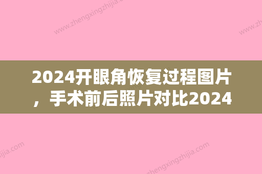 2024开眼角恢复过程图片，手术前后照片对比2024