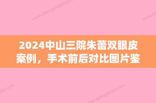 2024中山三院朱蕾双眼皮案例，手术前后对比图片鉴赏2024(中山大学附属第三医院颜玲割双眼皮)