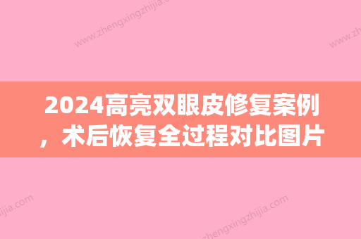 2024高亮双眼皮修复案例，术后恢复全过程对比图片展示(双眼皮手术3天恢复图)