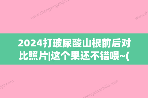 2024打玻尿酸山根前后对比照片|这个果还不错喂~(打山根用哪款玻尿酸好)