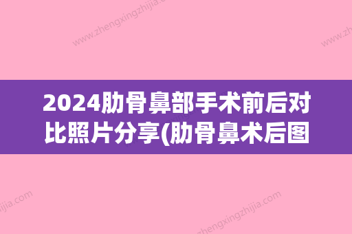 2024肋骨鼻部手术前后对比照片分享(肋骨鼻术后图)