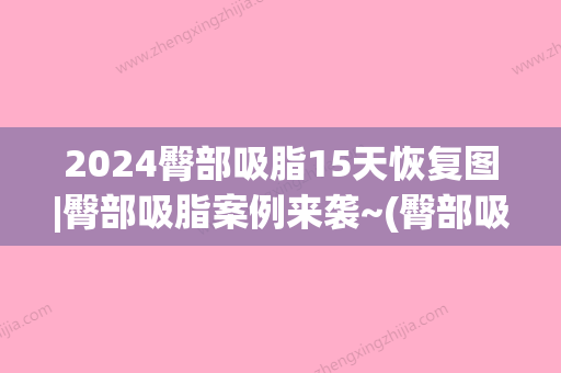 2024臀部吸脂15天恢复图|臀部吸脂案例来袭~(臀部吸脂多久可以恢复)