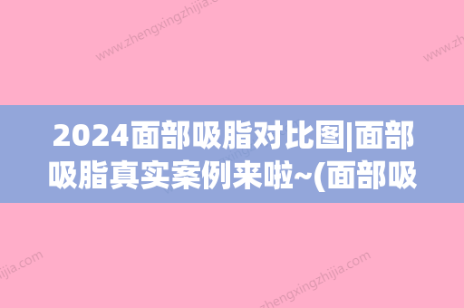 2024面部吸脂对比图|面部吸脂真实案例来啦~(面部吸脂图解)