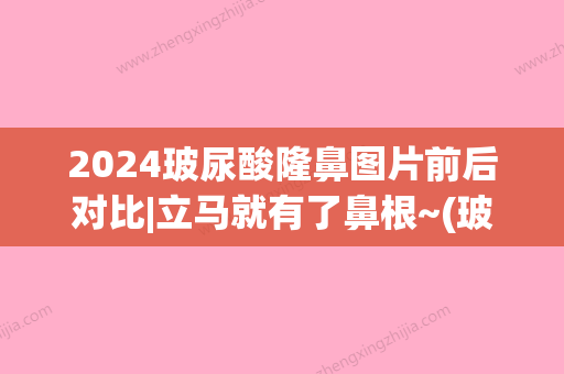 2024玻尿酸隆鼻图片前后对比|立马就有了鼻根~(玻尿酸隆鼻要几只)