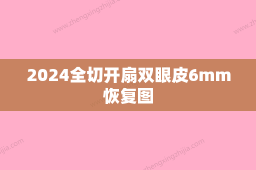 2024全切开扇双眼皮6mm恢复图